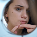 なぜニキビ・吹き出物ができるのか？