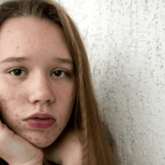 できてしまったニキビ跡のお手入れは?