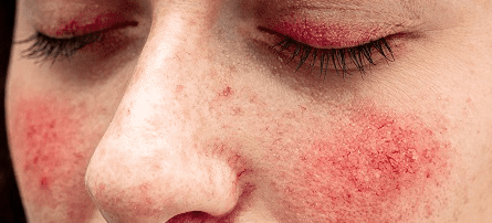 肌の赤みはアレルギー反応