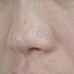 話題の角質培養で毛穴の角栓が取れるのか。やり方や危険性を徹底解説