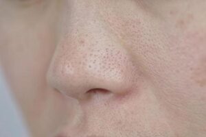 話題の角質培養で毛穴の角栓が取れるのか。やり方や危険性を徹底解説