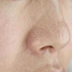 【閲覧注意】急に毛穴のブツブツが大量発生した原因と実際に毛穴詰まりを治した方法