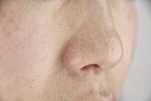 【閲覧注意】急に毛穴のブツブツが大量発生した原因と実際に毛穴詰まりを治した方法